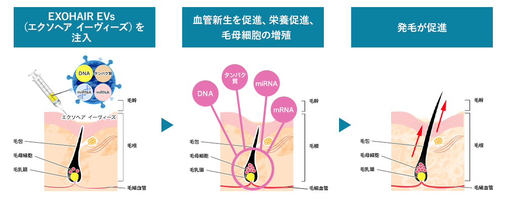 EXOHAIR EVs（エクソヘア イーヴィーズ）を注入→血管新生を促進、栄養促進、毛母細胞の増殖→発毛が促進