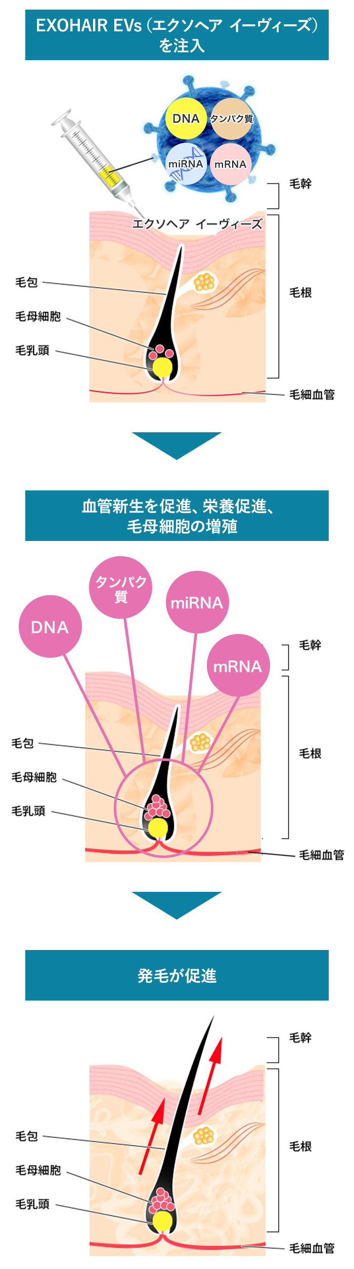 EXOHAIR EVs（エクソヘア イーヴィーズ）を注入→血管新生を促進、栄養促進、毛母細胞の増殖→発毛が促進